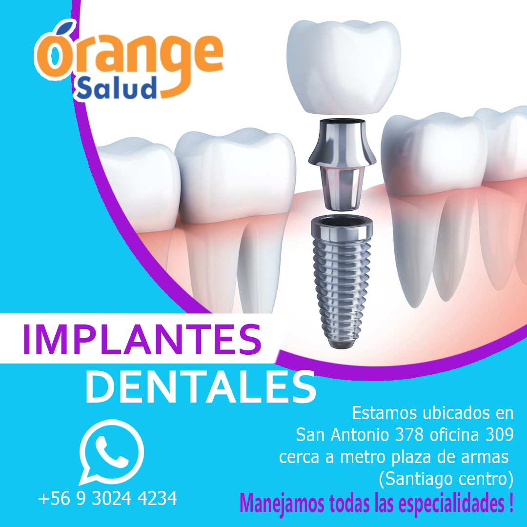 IMPLANTES