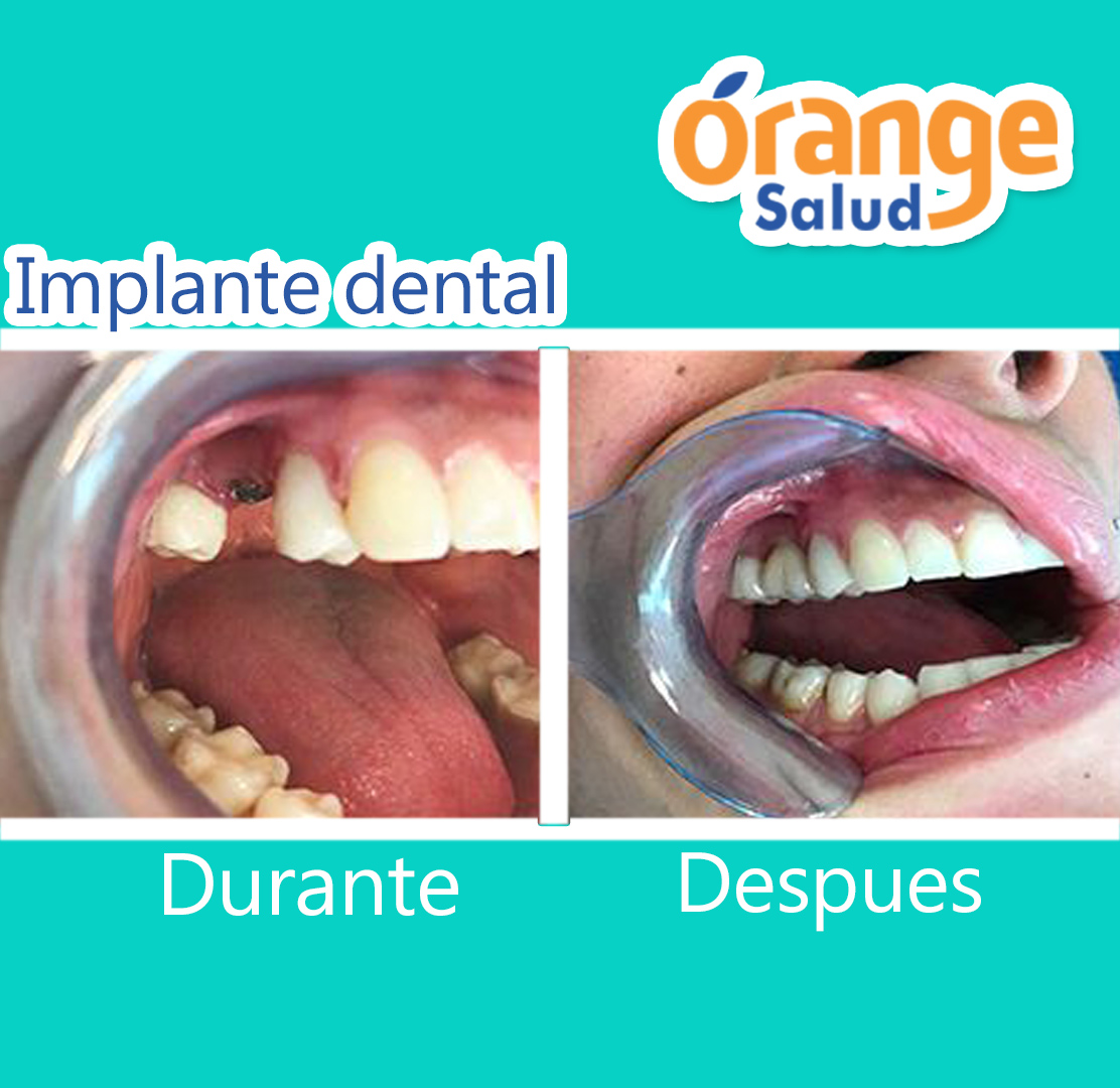 implante