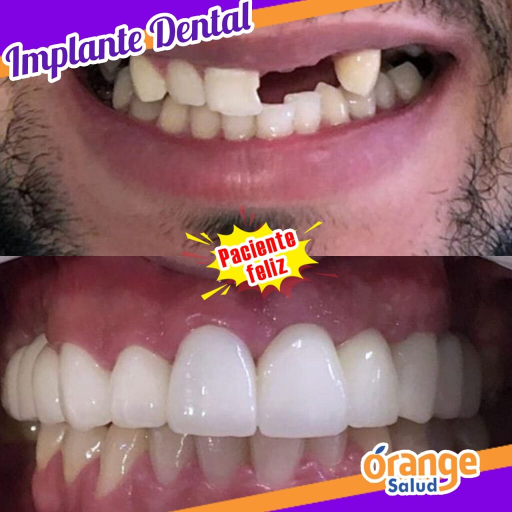 implantes-rangesalud02