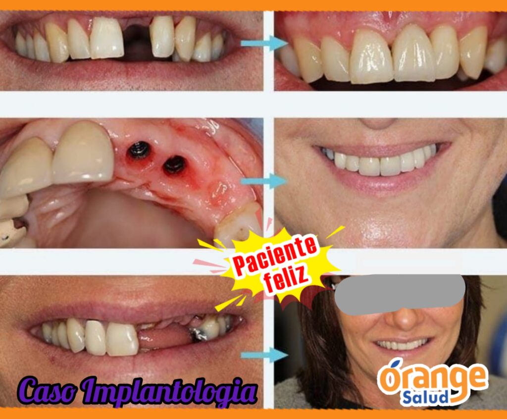 implantes-rangesalud04