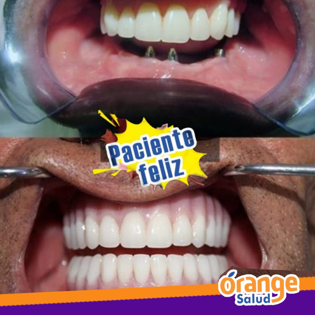 implantes-rangesalud05
