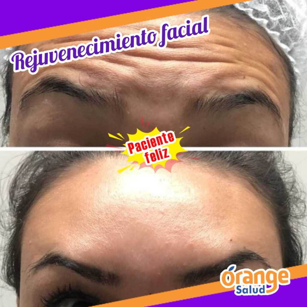 rejuvenecimiento-facial-02
