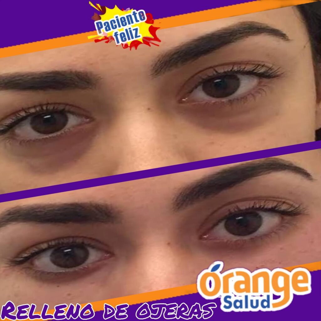 rejuvenecimiento-facial-03