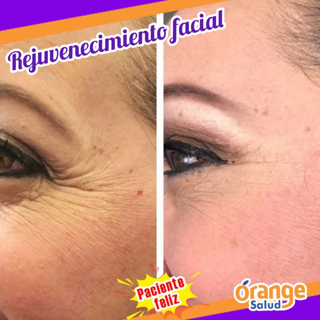 rejuvenecimiento-facial-04