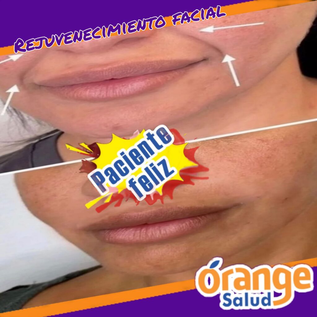 rejuvenecimiento-facial