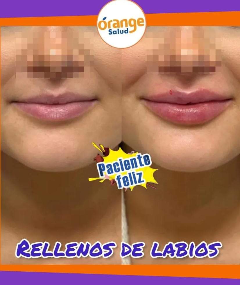 relleno-de-labios
